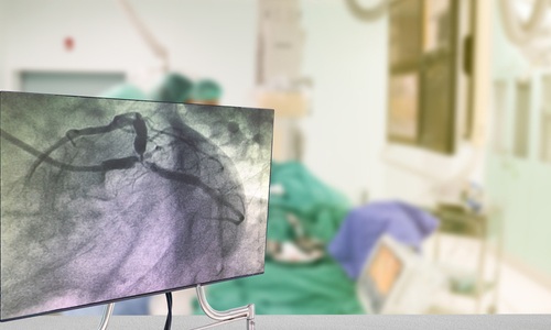 Image: Functional coronary angiography improved outcomes versus conventional angiography in STEMI patients with multivessel disease (Image Credit: Shutterstock)