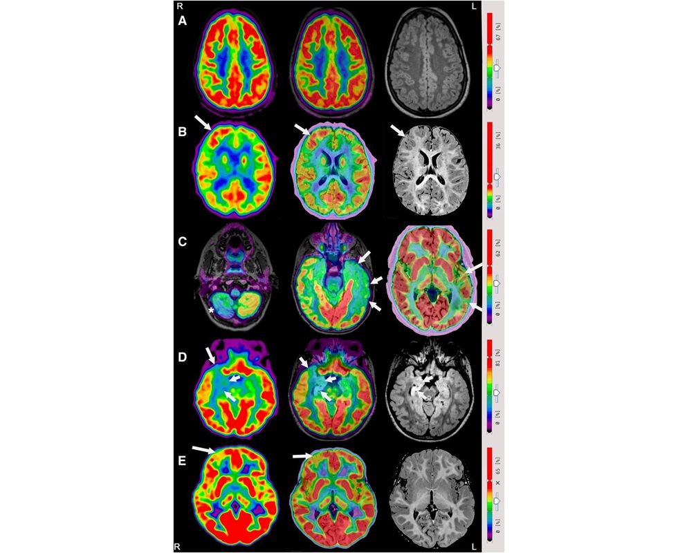 Image Credit: Credit: Diego Cecchin, MD, Unit of Nuclear Medicine, Department of Medicine, University-Hospital of Padova, Italy