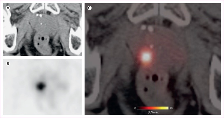 Image:  Representative case of clinically significant prostate cancer (Einspieler H, Hartenbach M, Grubmüller B et al., The Lancet Medical Imaging & Theranostics (2026). DOI: 10.1016/j.lanmit.2026.100004)