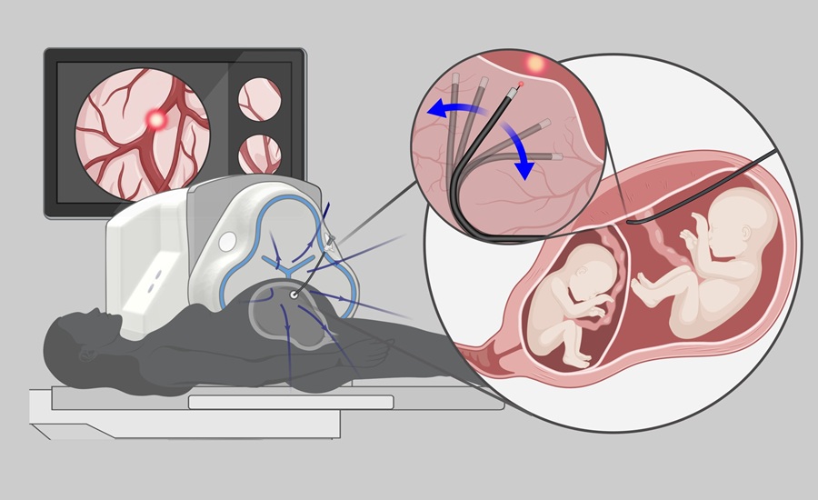 Image: The thin foetoscope is guided through the abdominal wall to the placenta. Small magnets in its tip react to an externally generated magnetic field, enabling the instrument to be bent with precision. The robotic platform is designed to occlude shared blood vessels in the placenta of twins with twin-to-twin transfusion syndrome. (Image Credit: created with BioRender.com, ETH Zurich)