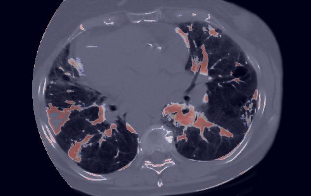 Image: CIPHER, an AI-powered CT foundation model, identifies patients with lung cancer at increased risk of immunotherapy-induced pneumonitis before treatment begins. The AI-generated output, shown here, highlights lung abnormalities to support early risk assessment and personalized patient care. (Image Credit: The University of Texas MD Anderson Cancer Center)