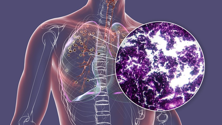 Image: only about 200 are available in the United States. Black lung and silicosis can develop after years of inhaling coal or rock dust, with severe breathing problems sometimes taking 10 to 20 years to appear (Image Credit: Adobe Stock)