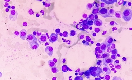 Image: Multiple myeloma is a cancer of plasma cells in the bone marrow that commonly causes painful bone lesions (Image Credit: Shutterstock)