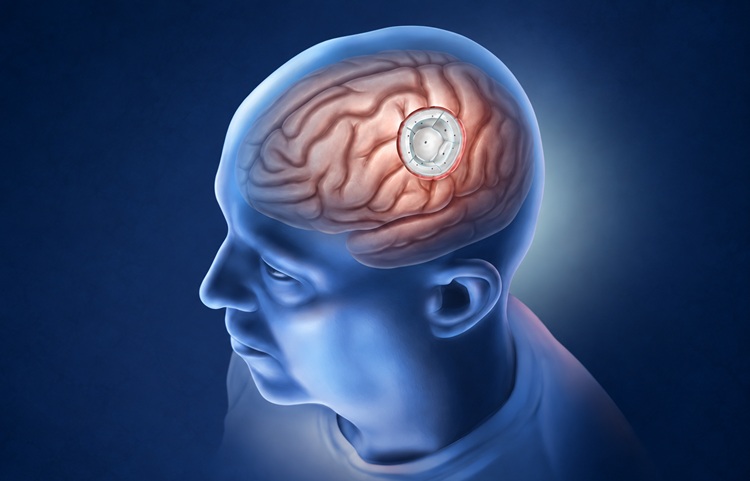 Image: GammaTile TBRT uses a FDA-cleared low-dose brachytherapy device. The postage stamp-sized tiles contain evenly spaced cesium-131 seeds embedded in a collagen matrix and are placed along the surgical cavity. (Photo courtesy of GT Medical Technologies Inc.)