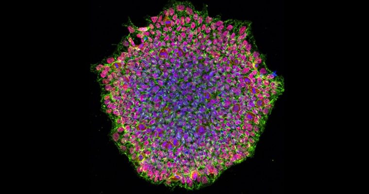 Sheets of heart muscle cells derived from induced pluripotent stem (iPS) cells were transplanted into a woman in her 50s during the hourlong surgery. (Image Credit: National Institutes of Health - Human induced pluripotent stem cell colony)