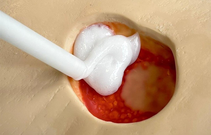 Image: The liquid silicone mixture is injected directly into the deep wound using a caulking gun. (Image Credit: AleSac)