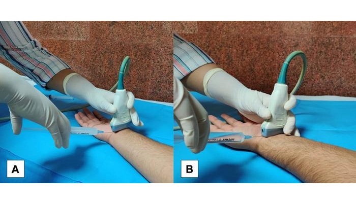 Image: Photographs depict the in-plane technique of needle insertion for the US-guided hydrodissection procedure using the (A) ulnar approach in right wrist carpal tunnel syndrome (CTS) and the (B) radial approach in left wrist CTS. (Photo courtesy of Radiological Society of North America)