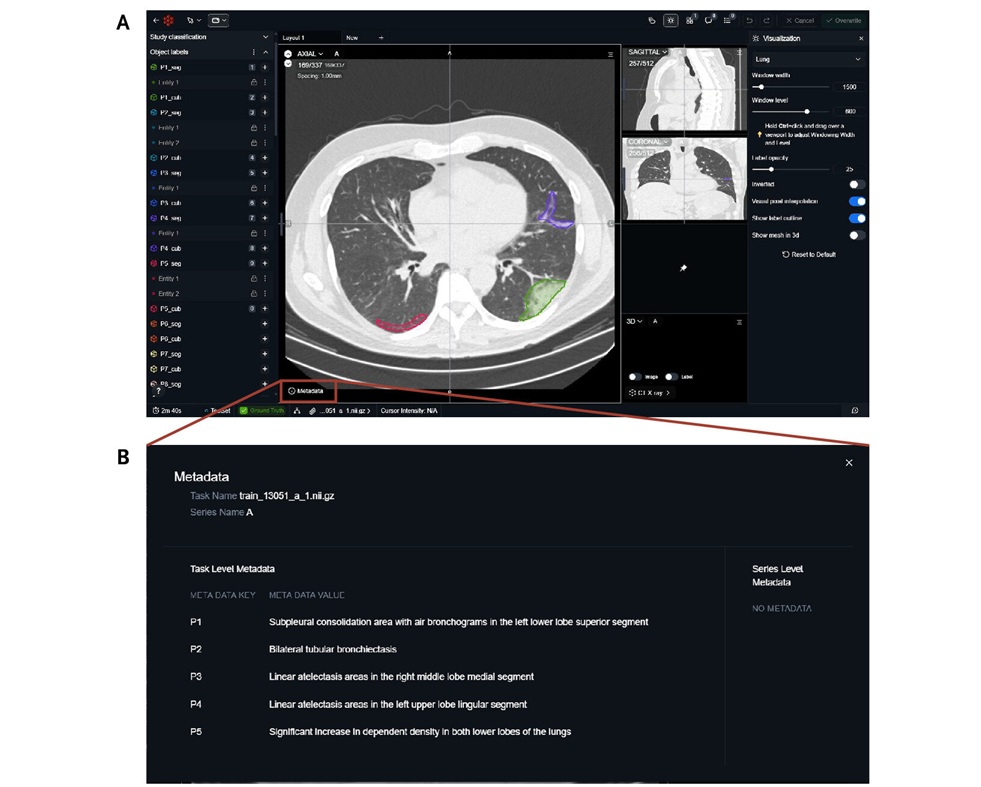Image: Annotation platform for pixel-level labeling of free-text findings in 3D chest CT. (Baharoon M, Luo L, Moritz M, et al. ReXGroundingCT: A 3D chest CT dataset for segmentation of findings from free-text reports. NEJM AI. 2026;3(7). doi:10.1056/AIdbp2501220.)