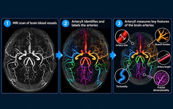 Image: The tool analyzes 3D time-of-flight MR angiography to measure brain vessel length, radius, volume, branching, tortuosity, and other structural features. (Photo courtesy of University of Rochester Medical Center)