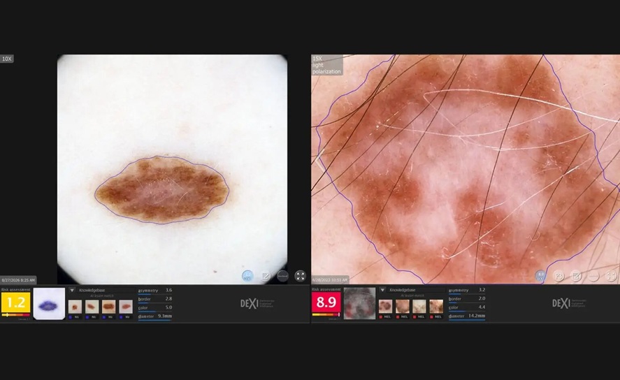 Image: Left - The image is of a non-cancerous skin lesion with a low-risk DEXI score of 1.2 and reassuring features (asymmetry, border, color and diameter) that help inform physicians that it should be monitored. Right -The image of an invasive melanoma with a high-risk DEXI score of 8.9 and features (asymmetry, border, color and diameter) that help inform physicians that it should be biopsied. (Image Credit: Mayo Clinic)