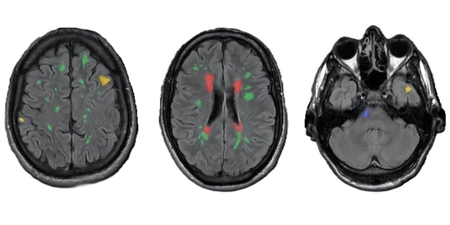 Image: The highlighted areas on MRI scans of patients with multiple sclerosis correspond to characteristic affected regions of various types. Modern computer vision models effectively detect the areas marked in red but have a hard time spotting the green ones. (Photo courtesy of Nadezhda Alsahanova et al.)