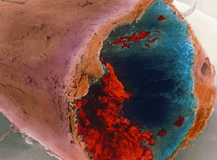 Image: Colored scanning electron micrograph (SEM) of a thrombus inside a coronary artery of the human heart (Photo courtesy of Professors P.M. Motta, G. Macchiarelli, S.A. Nottola / SPL).
