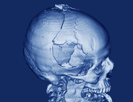 Image: Colored side view 3D CT scan of the fractured skull of a 40-year-old man, showing multiple fractures. The injury is due to an assault with depressed fractures the result of a high-energy impact from a blunt object (Photo courtesy of Zephyr / SPL). Image: Colored side view 3D CT scan of the fractured skull of a 40-year-old man, showing multiple fractures. The injury is due to an assault with depressed fractures the result of a high-energy impact from a blunt object (Photo courtesy of Zephyr / SPL).