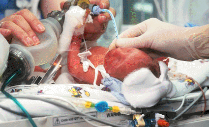 Image: Nurses using a bag and a tracheal tube to manually ventilate a premature baby experiencing respiratory distress (Photo courtesy of Eddie Lawrence / SPL).