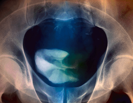 Image: Colored urogram of the pelvis of a 58-tyear-old patient with a malignant tumor in the left half of the bladder (Photo courtesy of Zephyr / SPL).