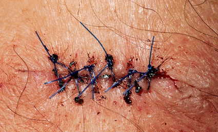Image: Skin cancer removal wound, shown two days after the surgical removal of a basal cell carcinoma (Photo courtesy of P. Marazzi / SPL). Image: Skin cancer removal wound, shown two days after the surgical removal of a basal cell carcinoma (Photo courtesy of P. Marazzi / SPL).