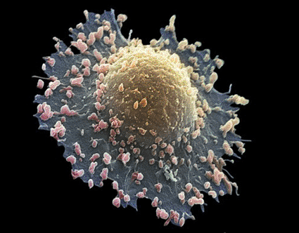 Image: Colored scanning electron micrograph (SEM) of a lung cancer cell (Photo courtesy of Steve Gschmeissner / SPL).