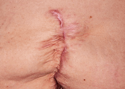 Image: Scar on the abdomen of a 54-year-old woman after the repair of an incisional hernia (Photo courtesy of Dr. P. Marazzi).