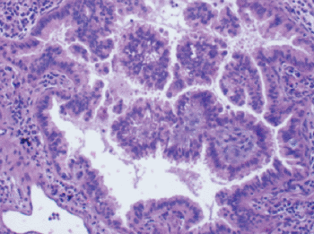 Image: Histology of a lung nodule excision showing papillary adenocarcinoma (Photo courtesy of iCytology).