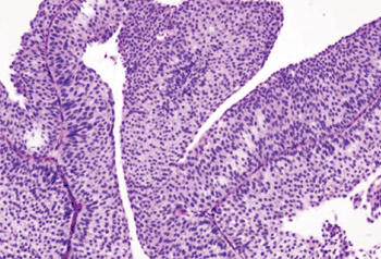 Image: Histopathology of urothelial carcinoma of the urinary bladder from a transurethral biopsy (Photo courtesy of Wikipedia).