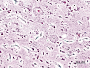 Image: Silver impregnation histopathogic image of amyloid plaques seen in the cerebral cortex of a patient with Alzheimer disease (Photo courtesy of Wikimedia Commons).