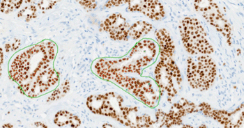 Image: VENTANA Companion Algorithm ER (SP1) image analysis algorithm (Photo courtesy of Ventana).