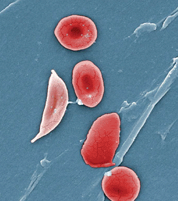 Image: Scanning electron micrograph of blood from a patient with sickle cell anemia (Photo courtesy of the OpenStax College).