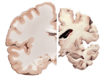 Image: Normal brain (left) compared with one from a severe case of Alzheimer’s disease (right) (Photo courtesy of US National Institute on Aging).