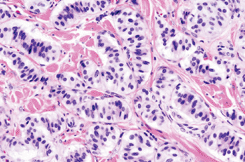 Image: Histopathology of pancreatic endocrine tumor (insulinoma) (Photo courtesy of Wikipedia Commons).