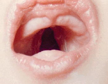 Image: An 8-month-old infant with an extensive cleft palate associated with the genetic condition Bamforth- Lazarus syndrome (Photo courtesy of Maynika V Rastogi and Stephen H LaFranchi).