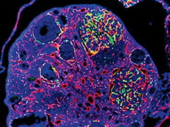 Image: A case where a primary kidney tumor spread to an ovary: The vectors gathering in the metastatic tumor vessels glow green. The red staining shows the normal blood vessels of the ovary (Photo courtesy of Dr. David T. Curiel and Dr. Jeffrey M. Arbeit, Washington University School of Medicine).