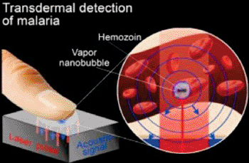 Image: Graphic shows how a laser pulse creates a vapor nanobubble in a malaria-infected cell and is used to noninvasively diagnose malaria rapidly and with high sensitivity (Photo courtesy of E. Lukianova-Hleb/Rice University).