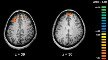 Image: A functional magnetic resonance image (fMRI) showing brain areas more active in controls than in schizophrenia patients during a working memory task. Schizophrenia has been linked to decreased autophagy and enhanced cell death (Photo courtesy of Wikimedia Commons).