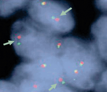 Image: A positive test with the Break Apart fluorescence in situ hybridization (FISH) Probe kit for anaplastic lymphoma kinase gene (ALK) (Photo courtesy of Abbott Molecular).