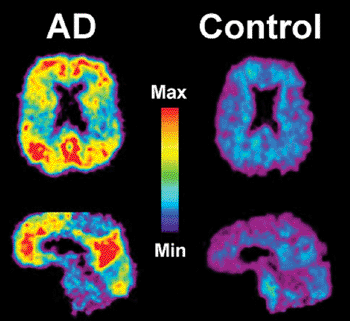 Image: Pittsburgh Compound B (PiB) positron emission tomography scan of a patient with Alzheimer\'s disease (AD) on the left; red and yellow show high concentrations of PiB in the brain and suggest high amounts of amyloid deposits in these areas (Photo courtesy of the University of Pittsburgh).