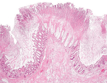 Image: Micrograph of colonic pseudomembranes in Clostridium difficile colitis (Photo courtesy of Nephron).