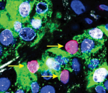 Image: Replicating human beta cells. In cells where p57 was successfully inhibited, beta cells could undergo DNA replication. Pink: nucleus that has undergone DNA replication. Green: Insulin. Blue: Nuclei counterstained for DNA. White: p57 (Photo courtesy of Dr. Klaus Kaestner, University of Pennsylvania).