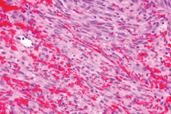 Image: Micrograph of KSHV-induced tumor showing abundant small branching blood vessels and spindle cells (Photo courtesy of Wikimedia Commons).