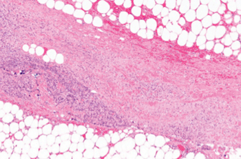Image: Micrograph (H&E stain) of necrotizing fasciitis, showing necrosis (center of image) of the dense connective tissue, i.e., fascia, interposed between fat lobules (top-right and bottom-left of image) (Photo courtesy of Wikimedia Commons).