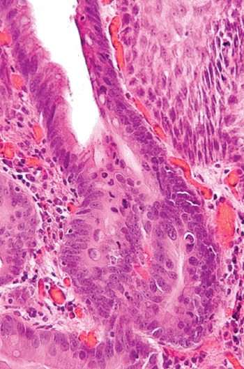 Cancer Patients Image: Micrograph of an intramucosal esophageal adenocarcinoma, a type of esophageal cancer (Photo courtesy of Nephron).
