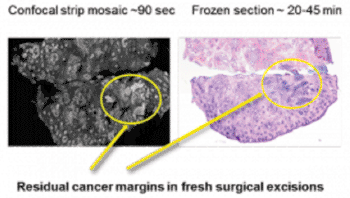 Image: Comparison of residual cancer detected with the new confocal imaging technique and the currently used freezing and staining technique (Photo courtesy of Dr. Milind Rajadyhyaksha, Memorial Sloan-Kettering Cancer Center).