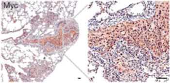 Image: Shown here is a tumor that metastasized from its original site in the prostate to the lung. Researchers were surprised to find the Myc protein in these tumors and, through further experiments, discovered that simply increasing the amount of Myc in the cell was enough to drive metastasis, suggesting a druggable target for metastatic prostate cancer (Photo courtesy of Cold Spring Harbor Laboratory).