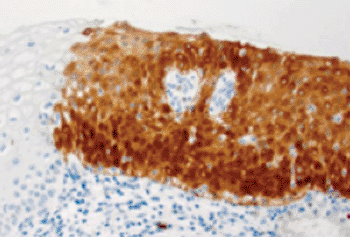 Image: Immunohistochemistry showing positive CINtec p16 staining (Photo courtesy of Ventana).