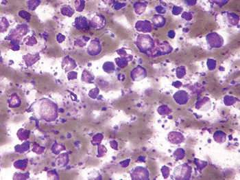 Image: Micrograph of large B-cell lymphoma from a fine needle aspirate of a lymph node (Photo courtesy of Nephron).