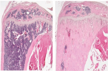 Image: As seen through a microscope, the leg bone of a normal mouse (left) makes considerably less new bone than a mouse that produces high levels of a signaling protein, WNT7B, that stimulates new bone growth (shown in pink on the right). The protein could become a target for new drugs to treat osteoporosis and other conditions related to bone loss (Photo courtesy of Washington University School of Medicine).