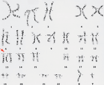 Image: Fetal chromosome test showing trisomy 13, indicated by red arrow (Photo courtesy of the National Human Genome Research Institute).