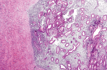 Image: Micrograph of endometriosis of the ovary (Photo courtesy of Nephron).