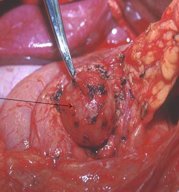 Image: A benign pancreatic cyst is evident at the tip of the clamp in this photo (Photo courtesy of the Indiana University School of Medicine).