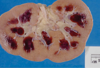 Image: Pathologic kidney specimen showing marked pallor of the cortex, contrasting to the darker areas of surviving medullary tissue; the patient died with acute kidney injury (Photo courtesy of Wikimedia and the author Haymanj).