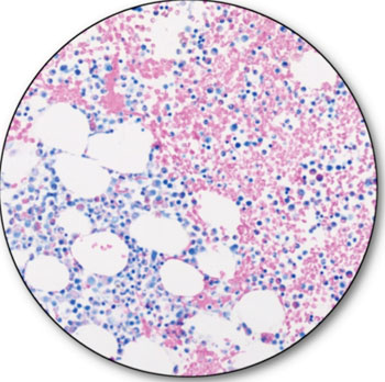 Caption: Bone marrow stained with Dako's Jenner-Wright Giemsa: nuclei – blue; eosinophils – bright pink; lymphocytes – shades of pink, gray, or blue depending on cell type and development (Photo courtesy of Dako).